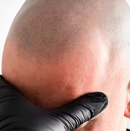 natural hairline with smp scalp micropigmentation Bristol Portishead hairline artistry north somerset nailsea weston super mare clevedon blackwell