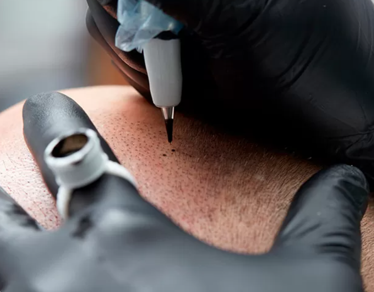 Scalp Micropigmentation near Bristol Portishead hairline artistry SMP treatment hair tattoo